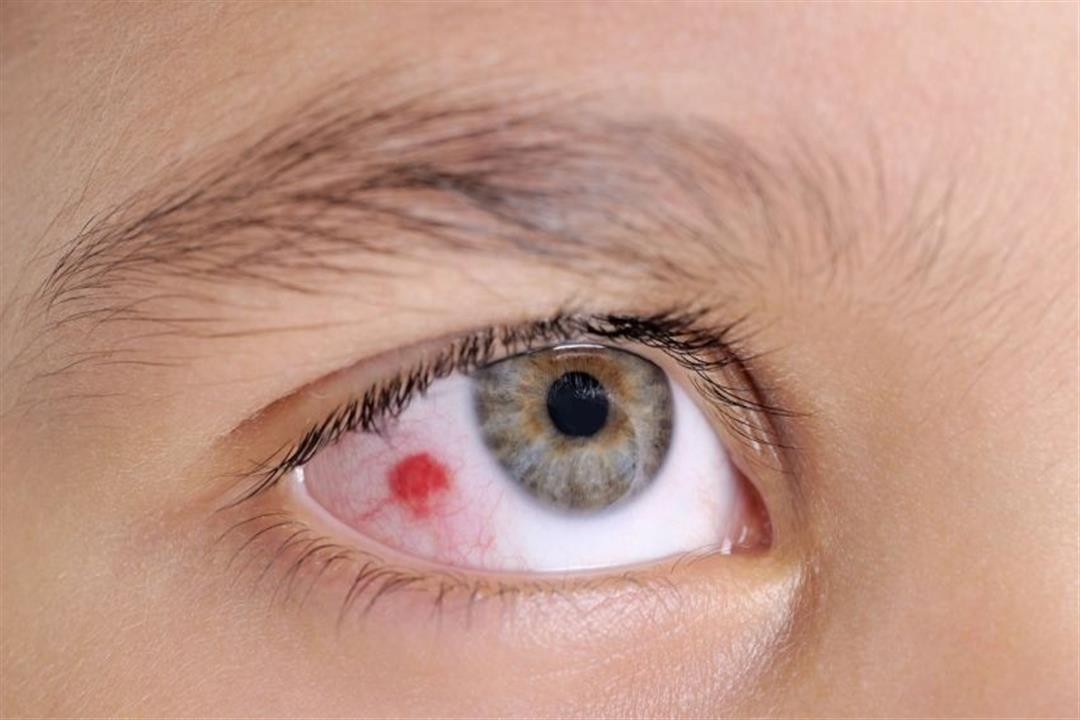 ظهور الدم في زاوية العين.. متى تستدعي هذه المشكلة زيارة الطبيب؟