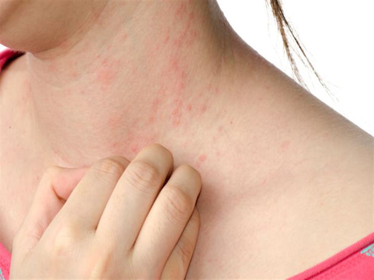 هل الأمراض الجلدية علامة على الإصابة بكورونا؟