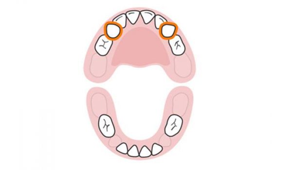 الأسنان اللبنية النابان العلويان