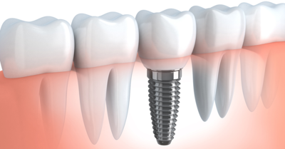 أسباب ومخاطر جراحة زراعة الأسنان
