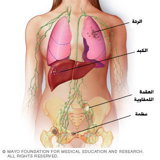 المرحلة الرابعة من سرطان الثدي
