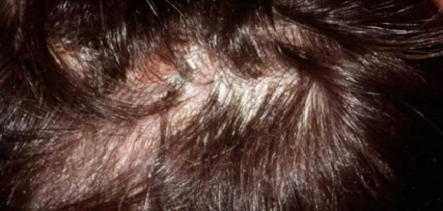 علاج التهاب بصيلات الشعر بالاعشاب