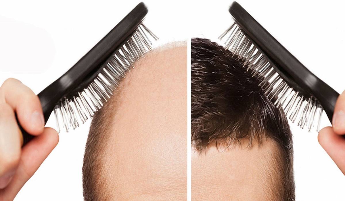 تقنية DHI لزراعة الشعر