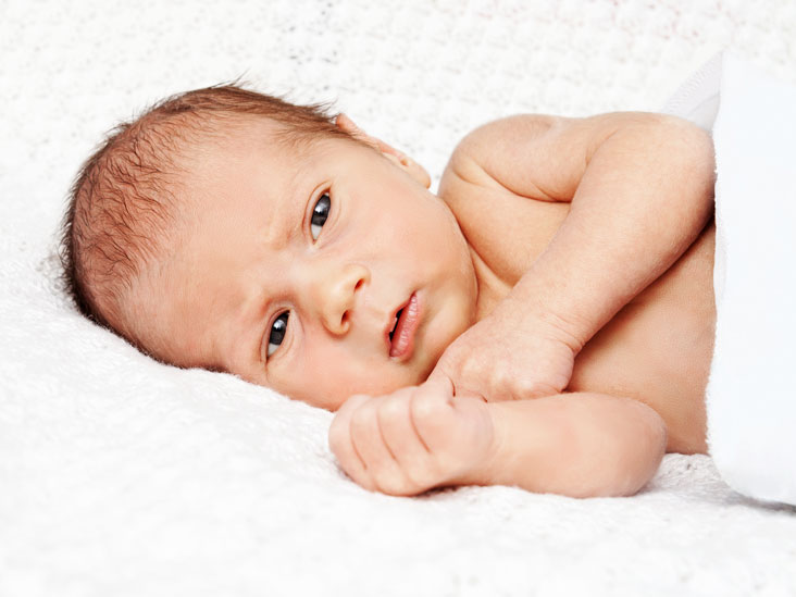 Image result for jaundice in newborn