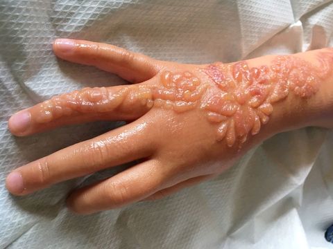 Image result for henna tattoo side effects