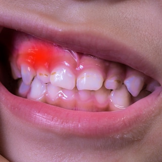 أمراض اللثة والأسنان