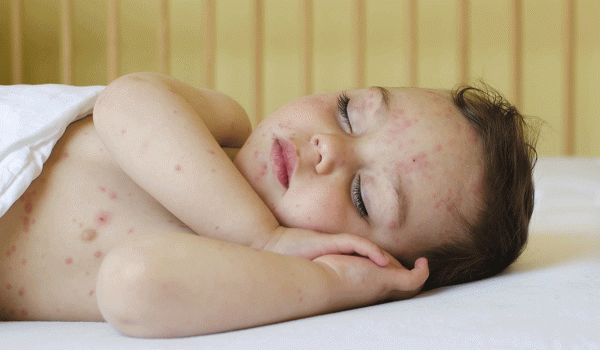 الطفح الجلدي عند الاطفال