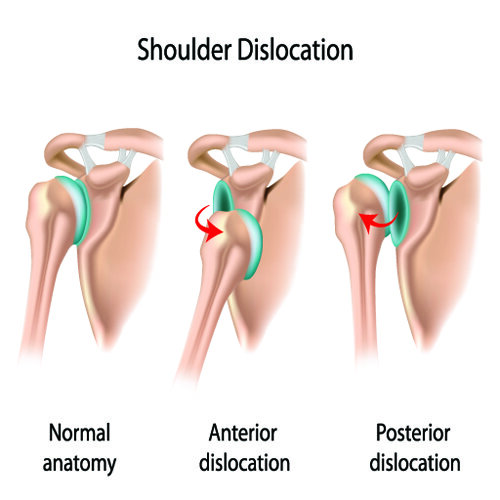 Image result for shoulder dislocation