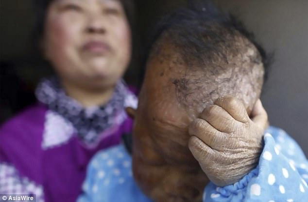 Tianfang's skin starts cracking when the weather gets cold. He and her mother live at the Wangfan Village of Yuexi County in eastern China's Anhui Province