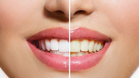 تغير لون الأسنان: الأسباب و العلاج