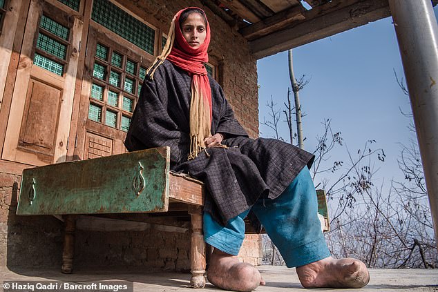 Tawheeda Jan has lymphatic filariasis - a condition more commonly known as elephantiasis
