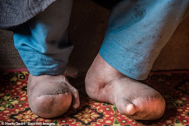 Ms Jan even had to stop attending school because her condition made it impossible to make the journey there (pictured: her feet)