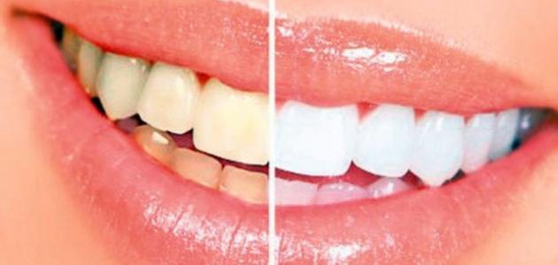 اصفرار الاسنان من الداخل