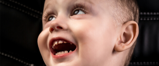 كل ما تريد معرفته عن تسوس أسنان الرضع