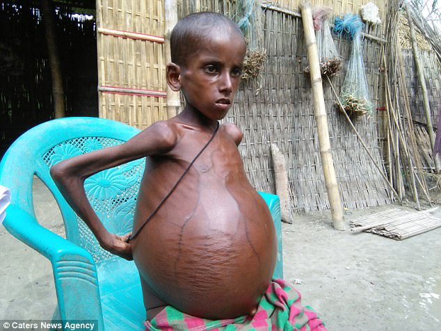 Shahanur Alam, seven, is so skinny that just his bones are visible, but his stomach has protruded so much that he is now immobile
