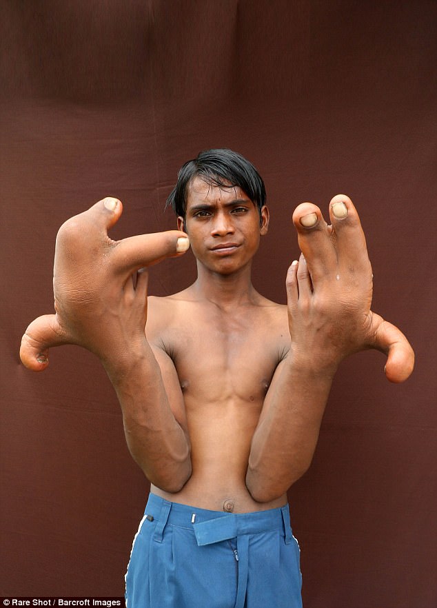 A mysterious condition has caused a boy's, 12, hands to grow 12 inches in length