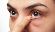 أسباب وأعراض رفرفة العين