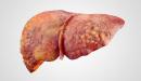 أعراض ارتفاع إنزيمات الكبد