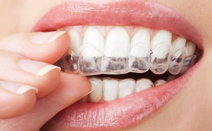 تقويم الاسنان الشفاف
