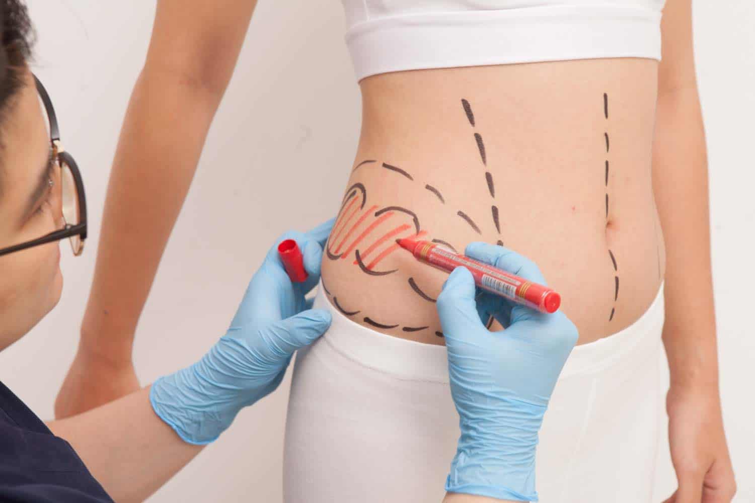 عمليات شفط الدهون مميزاتها واضرارها واهم التقنيات المستخدمة liposuction -  Hoouri Store