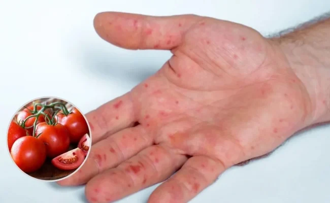 ما هي انفلونزا الطماطم