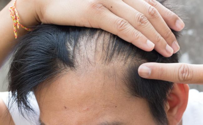 علاج الشعر الخفيف وراثيًا
