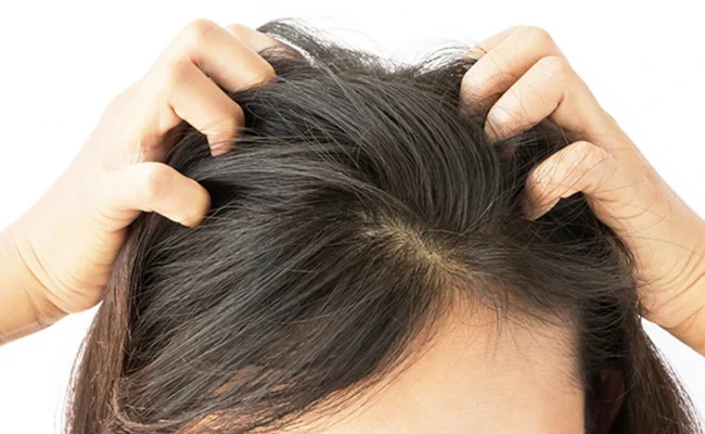 علاج صدفية الشعر في المنزل